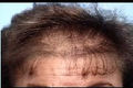 Hair Loss Women 848.jpg